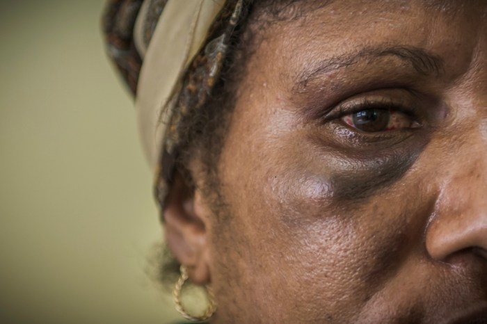 Women with black eye following inter-partners violence